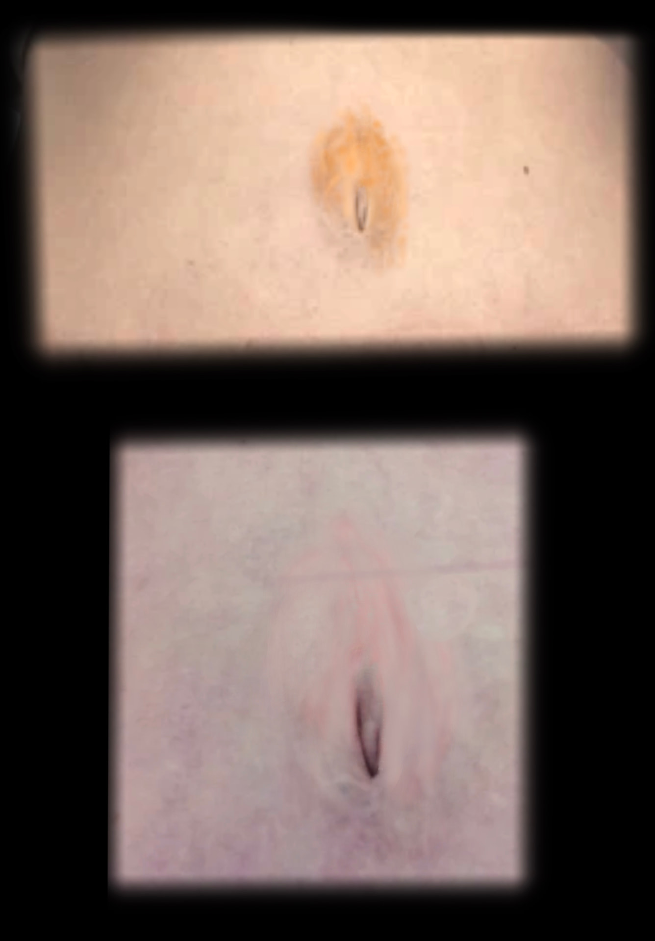 Before and after surgical scar camouflage on torso