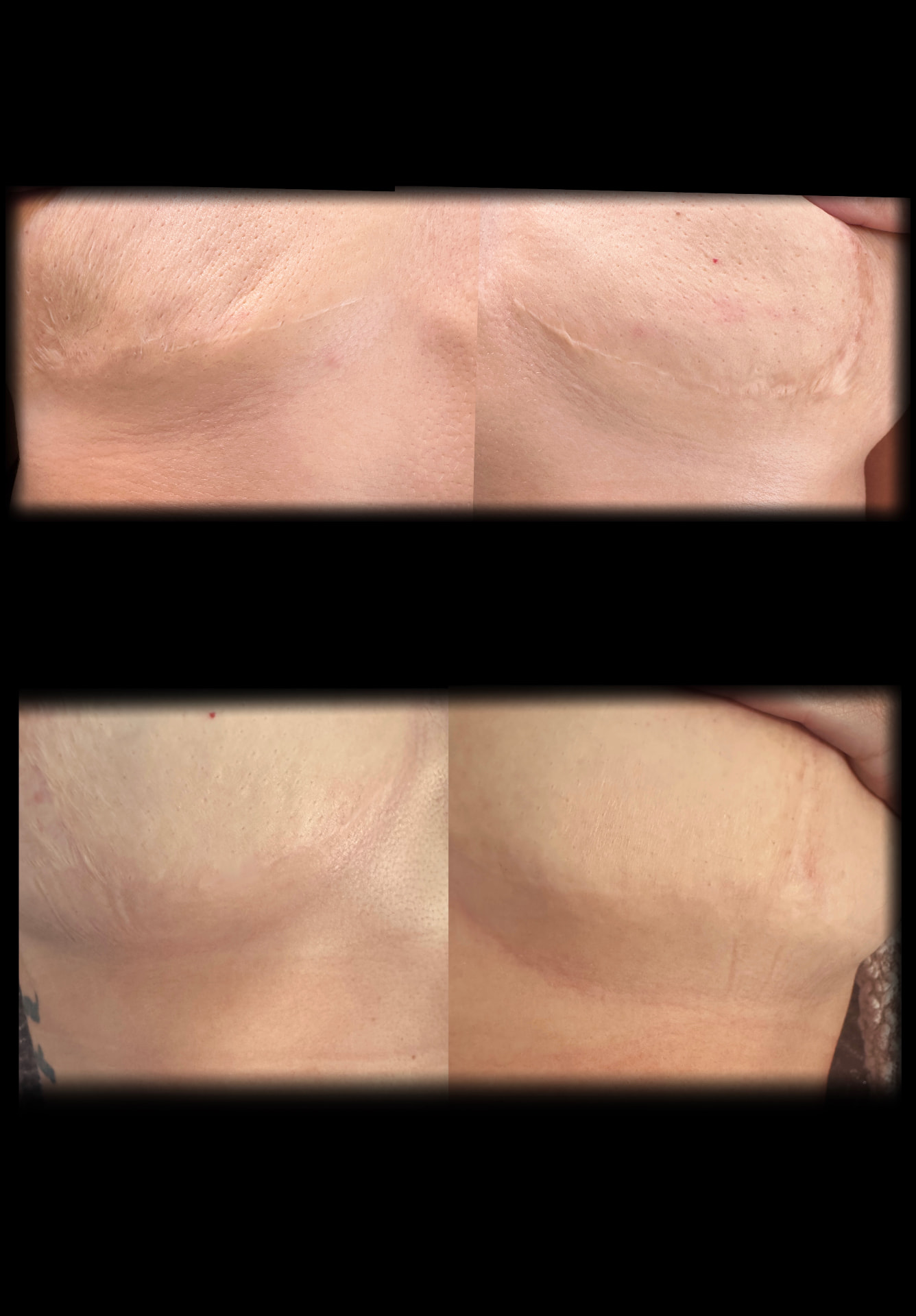 Before and after scar camouflage on the back