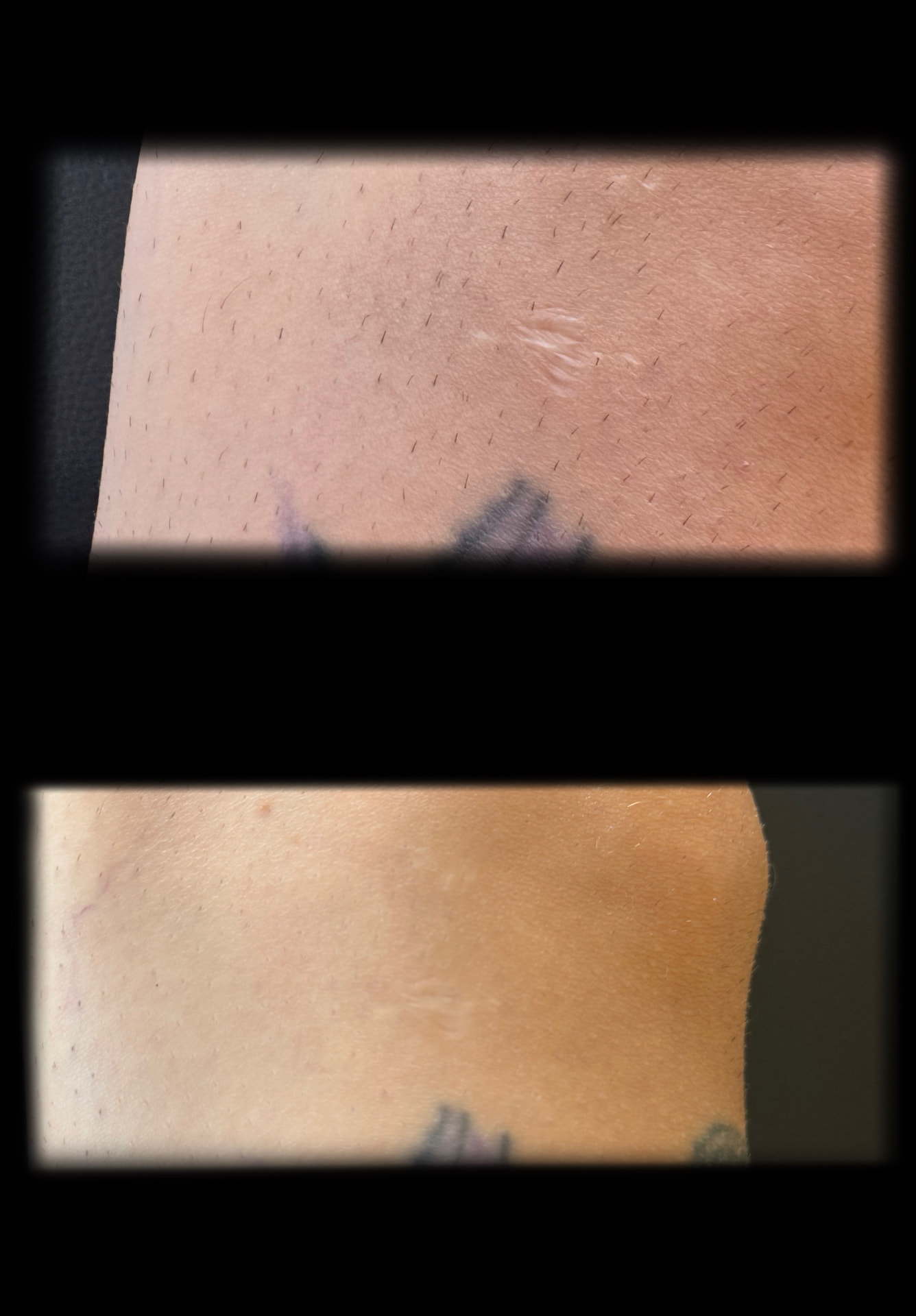 Before and after surgical scar camouflage on torso